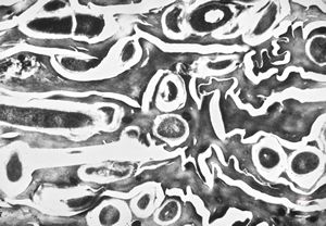 M,44y. | dermatomycosis M,44y. | dermatomycosis